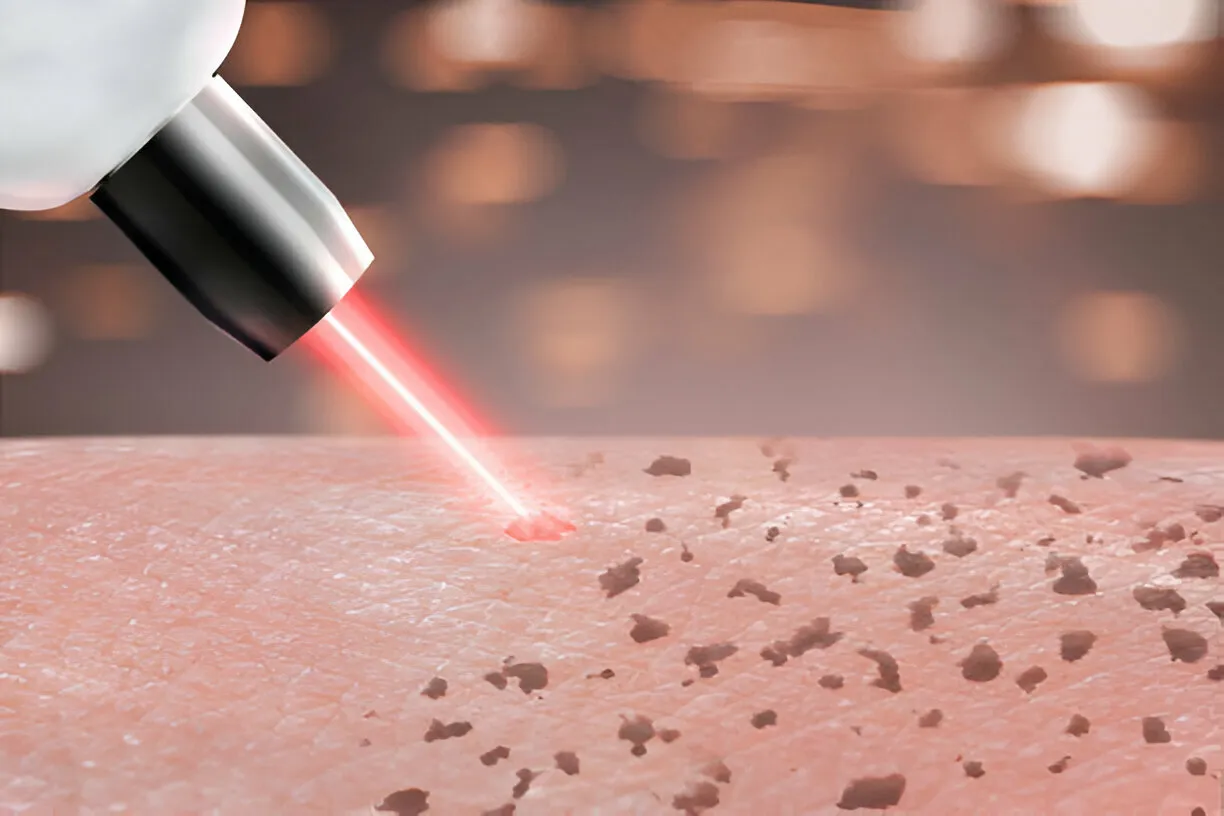 The Science Behind Laser Treatments: What to Expect from a Professional Skin Clinic